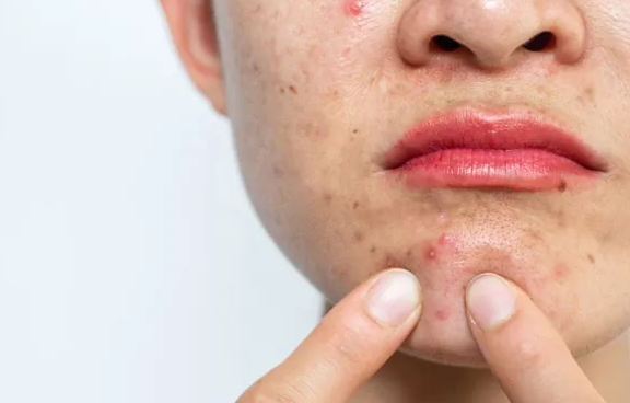 ۶ اشتباهی که هنگام جوش زدن مرتکب میشوید